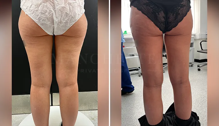 vaser liposuction thighs before after patient