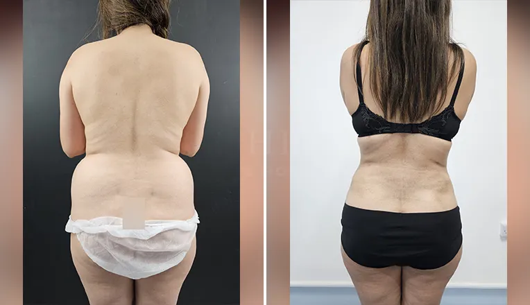 back vaser lipo before and after-2