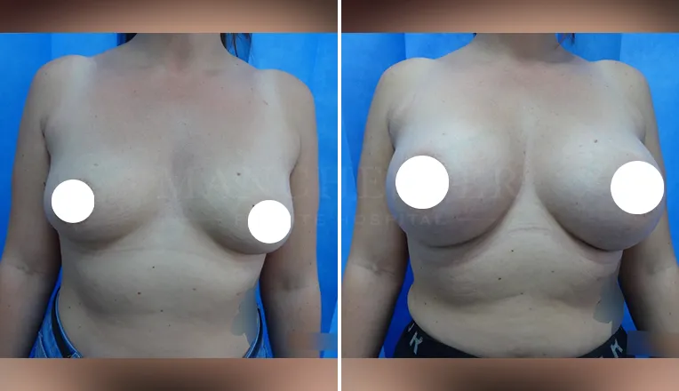 boob job before and after patient - 2 - v1