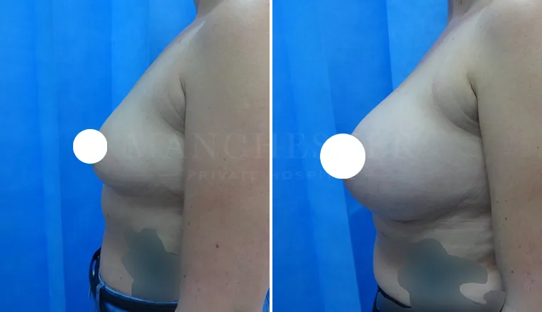boob job before and after patient - 2 - v3