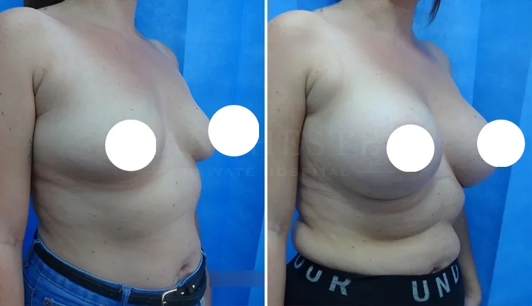 boob job before and after patient - 2 - v4