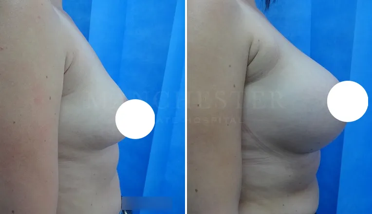 boob job before and after patient - 2 - v5