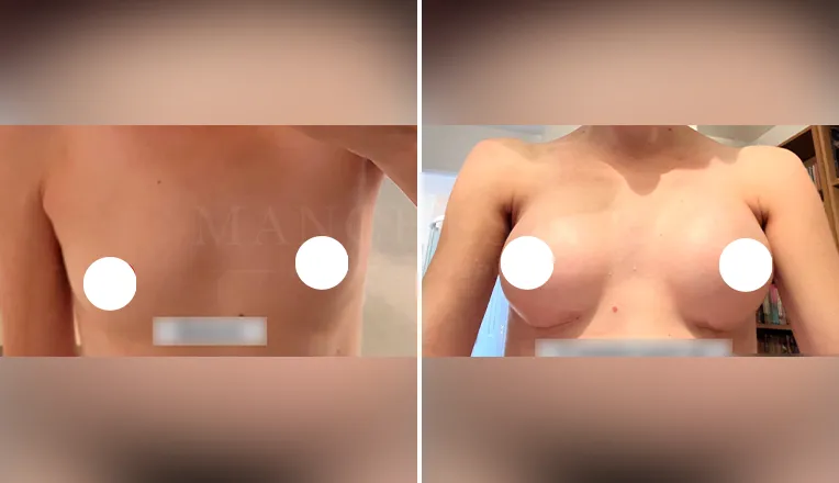 breast augmentation before and after patient - 2