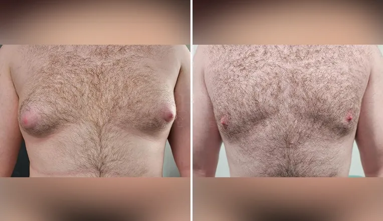 gynecomastia liposuction before and after patient -5- v1