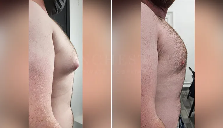 gynecomastia liposuction before and after patient -5- v3