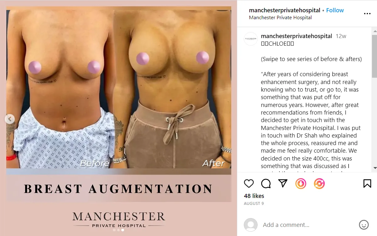 mph breast augmentation angel-5-v3