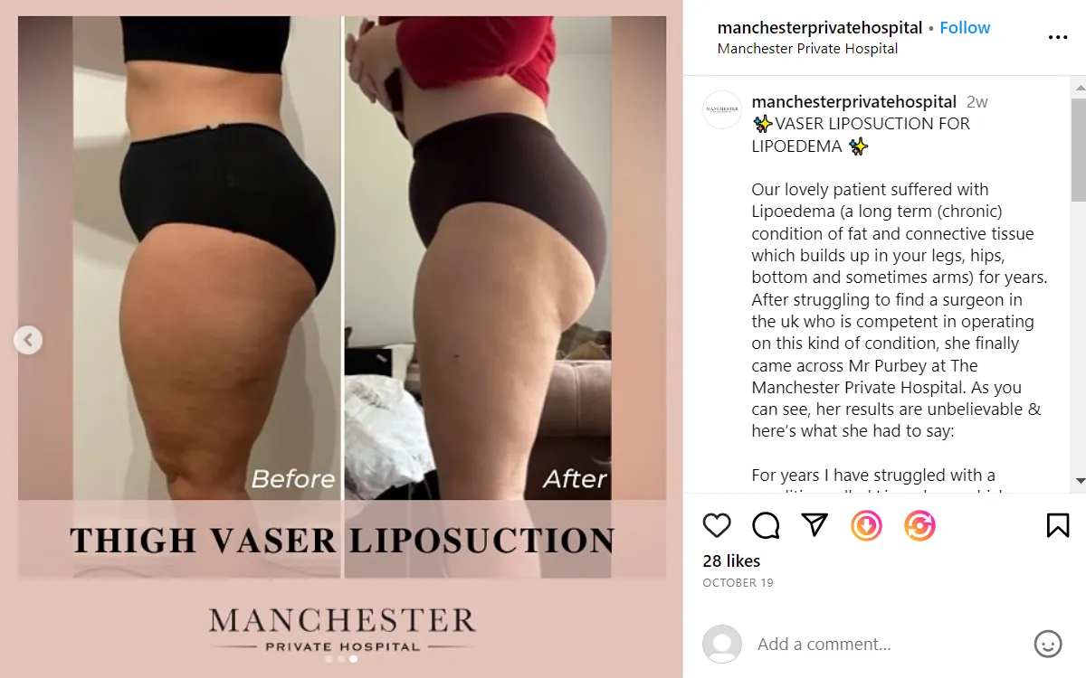 mph thigh vaser liposuction angel-1-v3