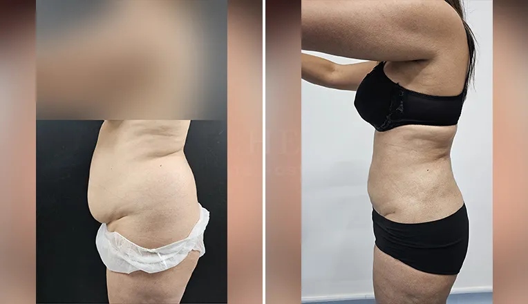 vaser lipo female abs before and after-2