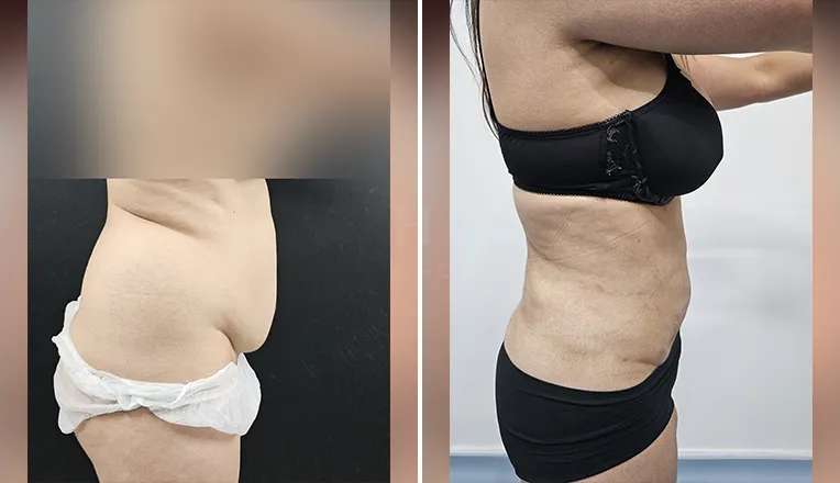vaser liposuction female abs before and after-2