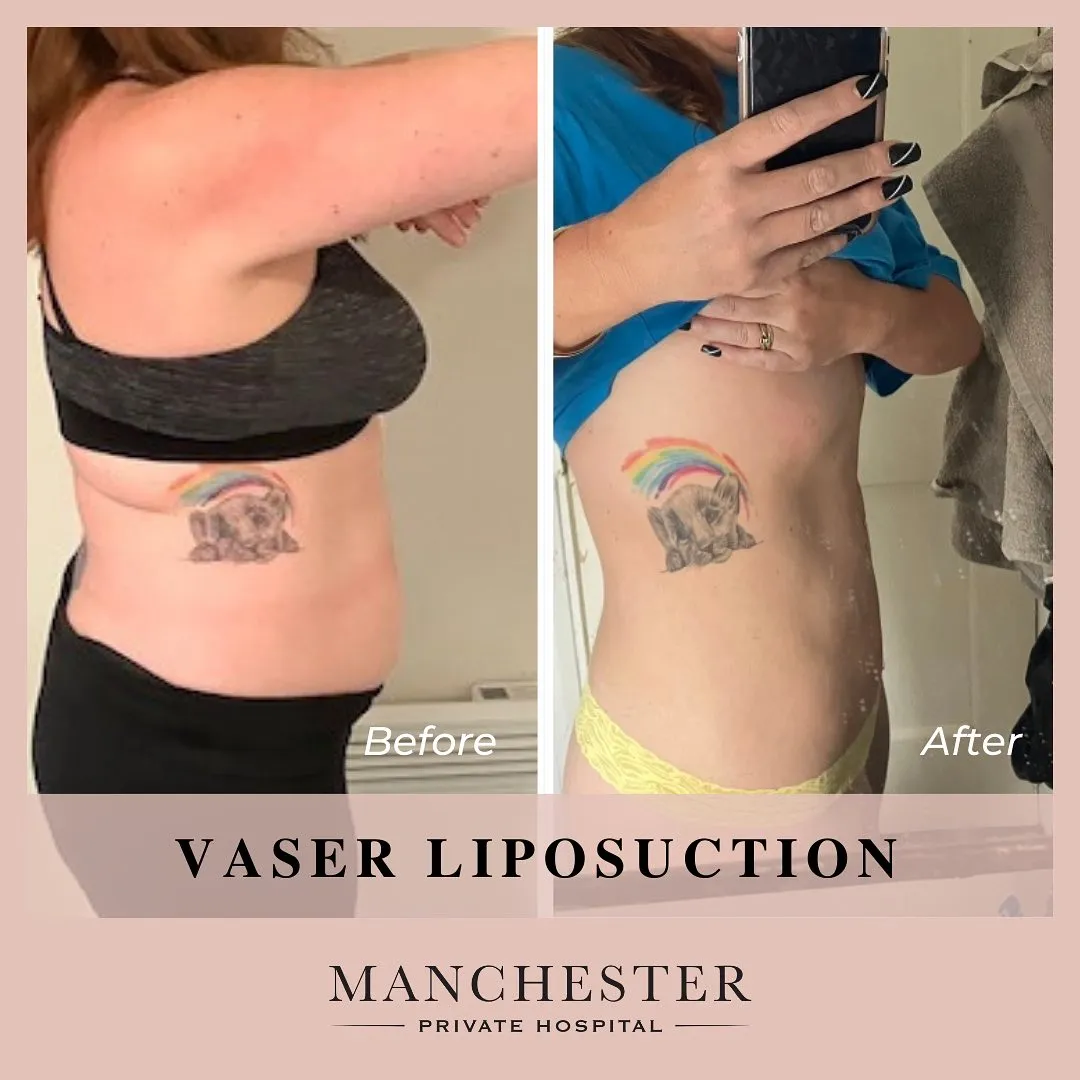 vaser liposuction patient result-2