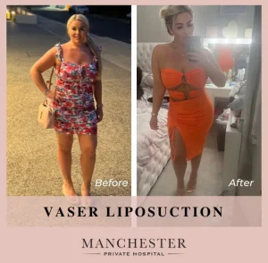 vaser liposuction patient result-3