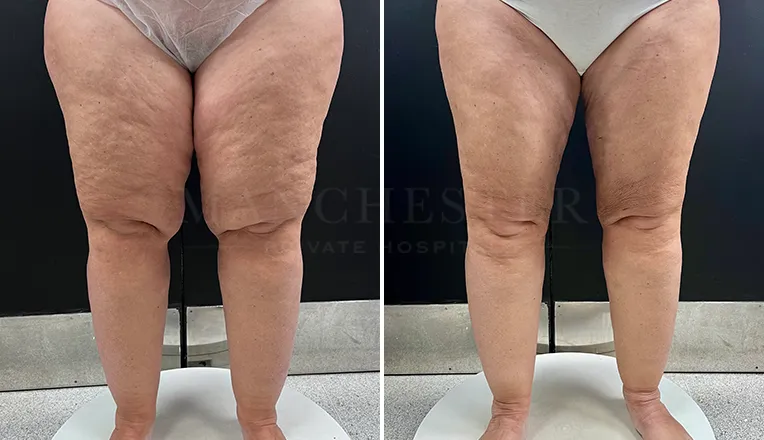 before and after lipedema knees patient 4