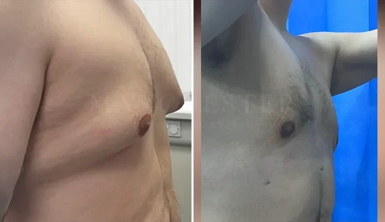 gynecomastia liposuction before and after patient-7