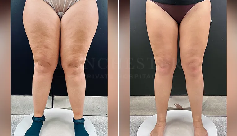 lipedema liposuction before and after patient 1-v1