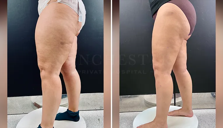 lipedema liposuction before and after patient 1-v2