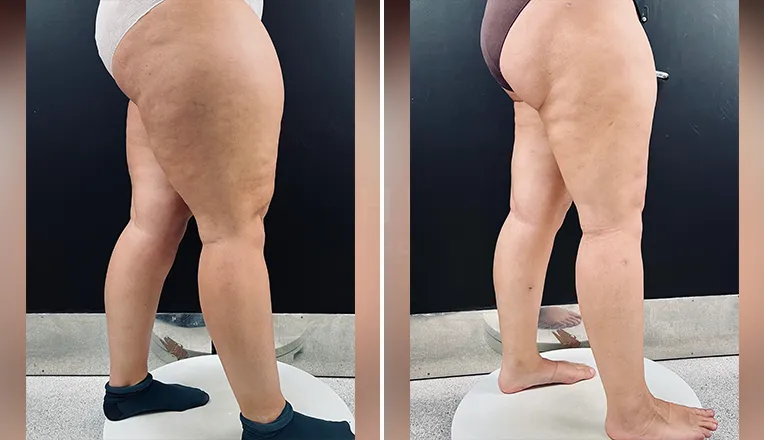 lipedema liposuction before and after patient 1-v3