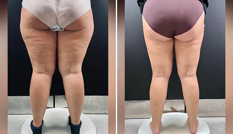 lipedema liposuction before and after patient 1-v4