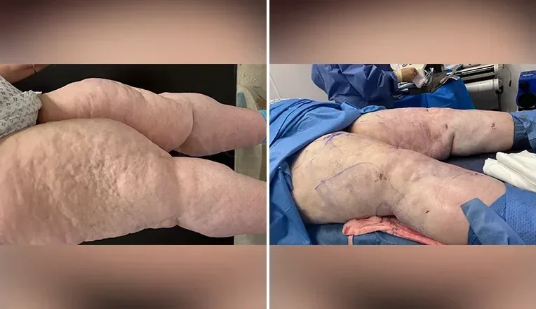 lipedema liposuction treatment before and after patient 3