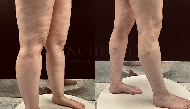 lipedema surgery before and after patient 2-v2