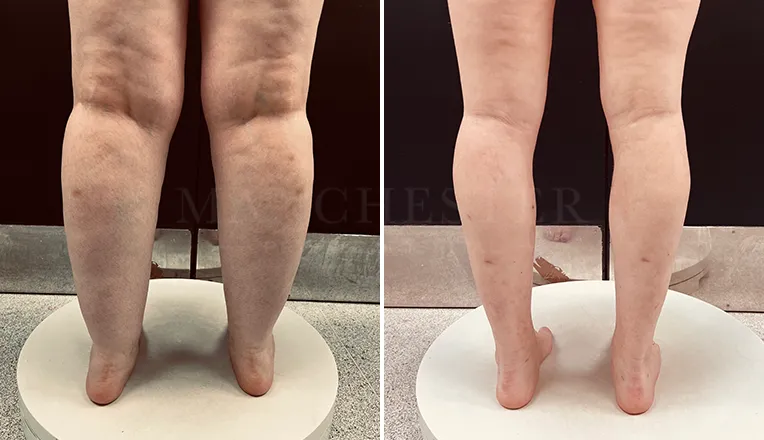 lipedema surgery before and after patient 2-v3