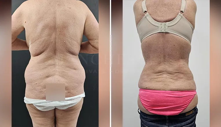 vaser lipo female abs before and after-1-v2