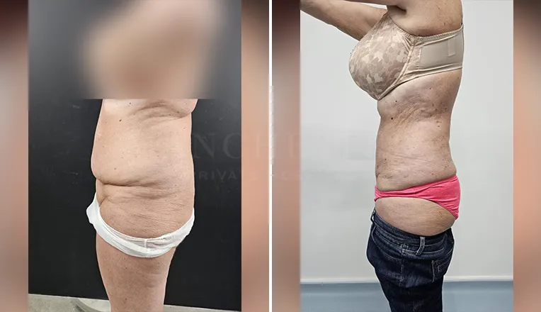 vaser lipo female abs before and after-1-v3