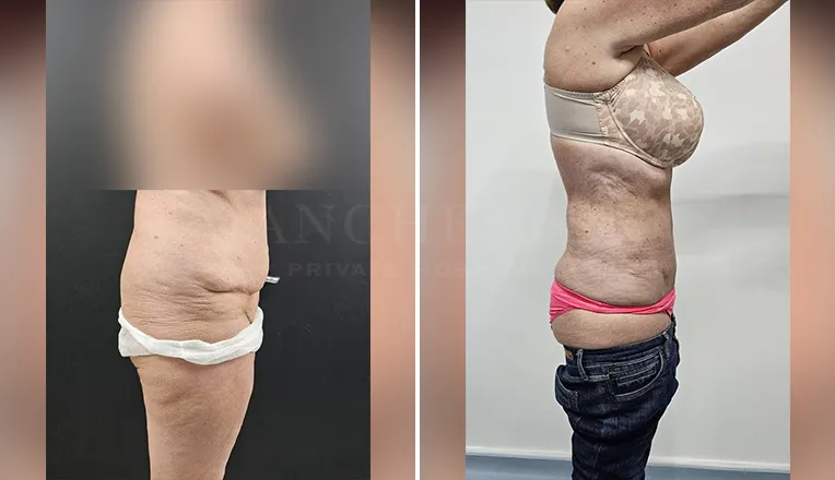 vaser lipo female abs before and after-1-v4