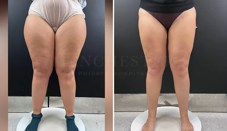 vaser liposuction legs before and after patient-5