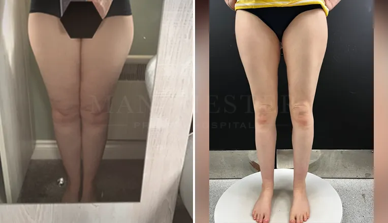 vaser liposuction legs before and after patient-6