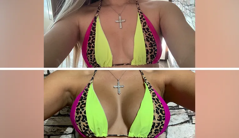 breast enlargement before and after patient-8