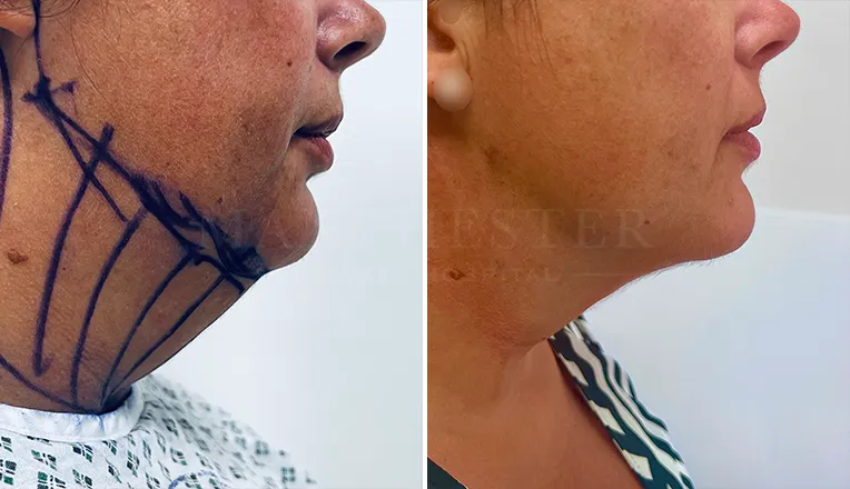 facial vaser liposuction results-1-v3