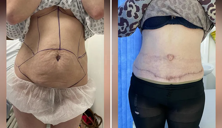 tummy tuck before and after-1
