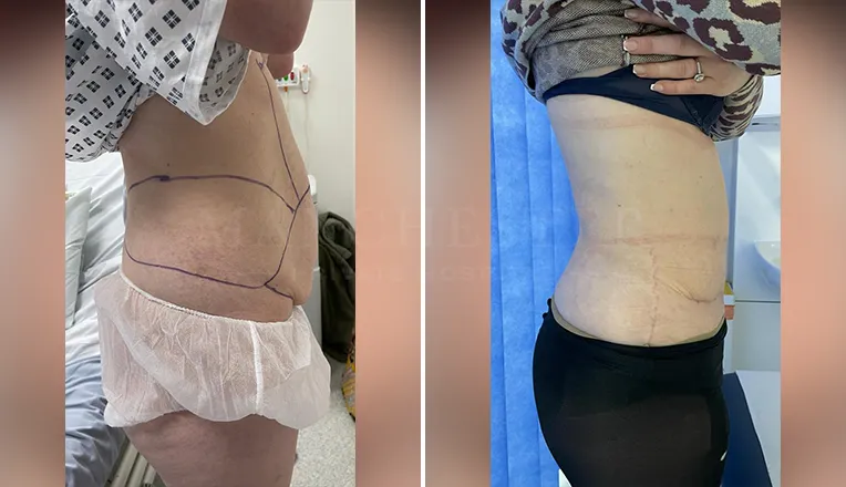 tummy tuck before and after-2