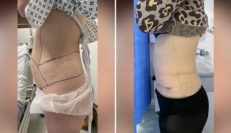 tummy tuck before and after-3