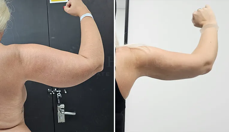 vaser liposuction arms before and after-2-v1