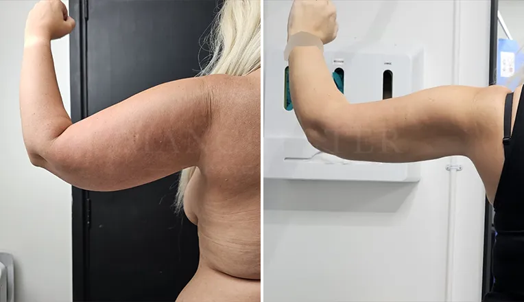 vaser liposuction arms before and after-2-v2