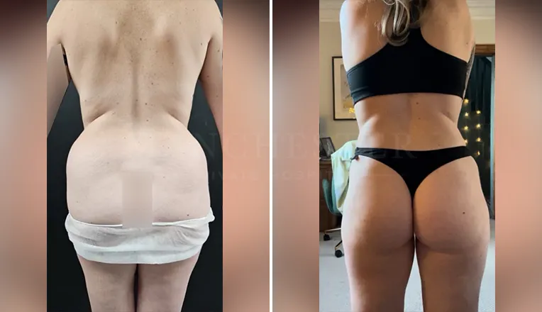 back vaser lipo before and after-9