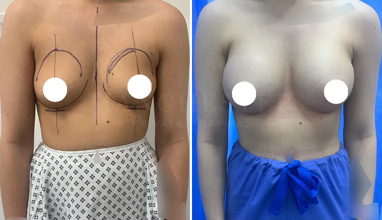 boob-job-before-and-after-patient-5