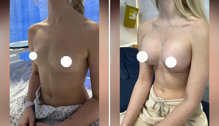 breast enlargement patient-4