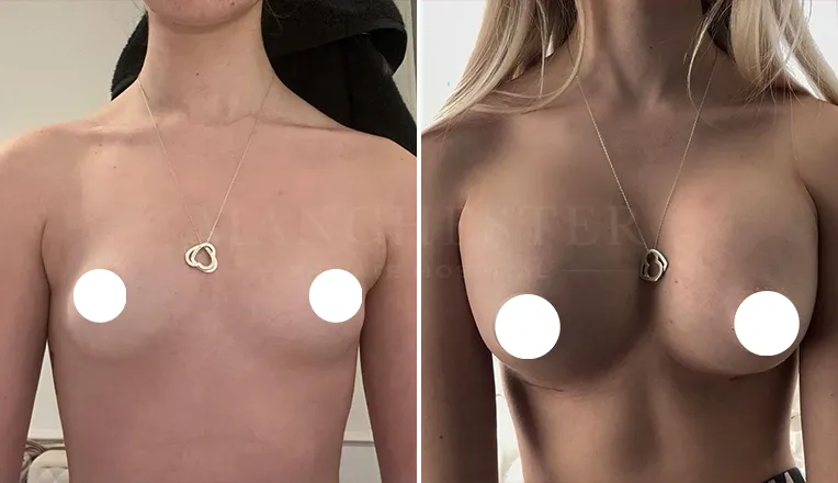breast enlargement patient results-9-v1