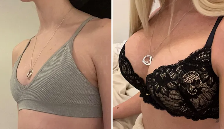 breast enlargement patient results-9-v3