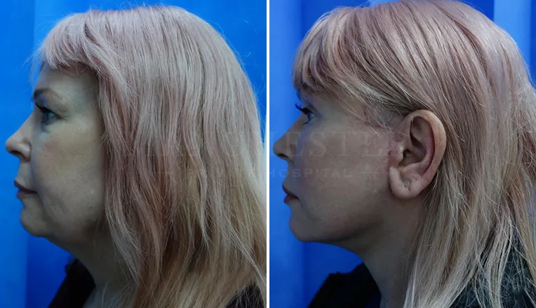 facelift before and after result-5-v2