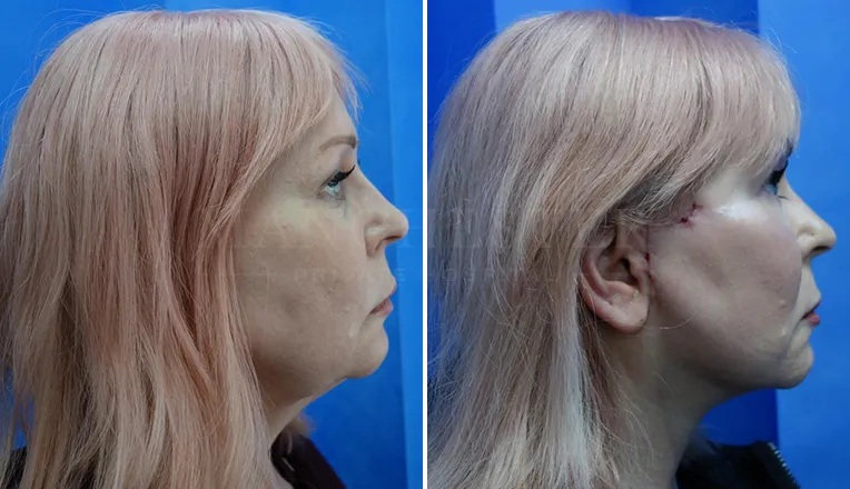 facelift before and after result-5-v3
