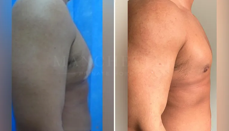 gynecomastia before and after patient-5-v2