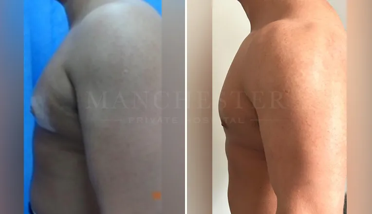 gynecomastia before and after patient-5-v3