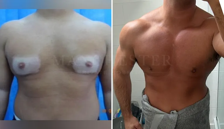 gynecomastia before and after patient-5