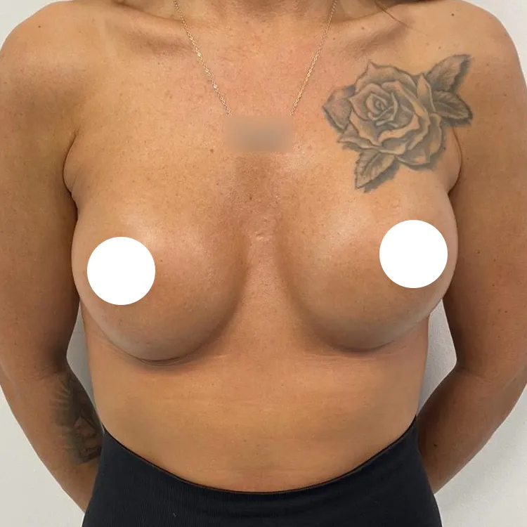mph breast enlargement patient-52
