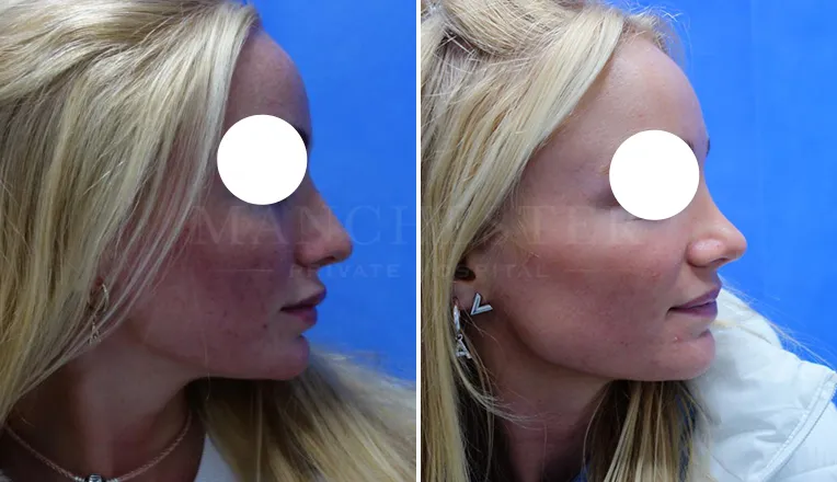 rhinoplasty before and after patient-5-v2