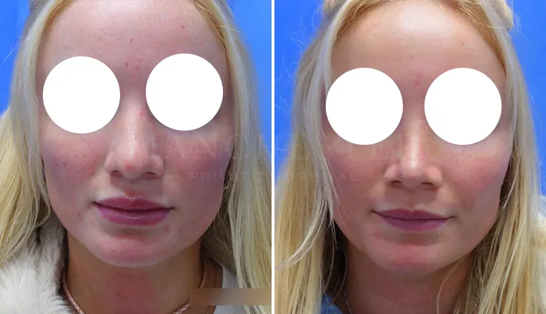 rhinoplasty before and after patient-5