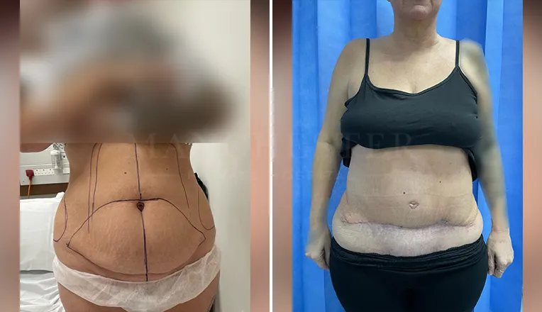 tummy tuck before and after result-8-v1